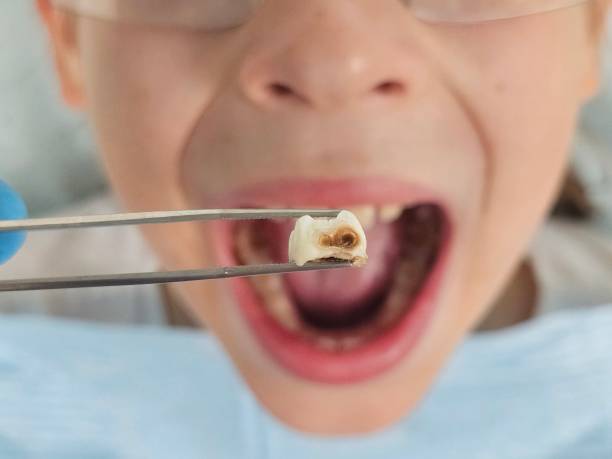 Best Emergency Dentist for Lost Fillings or Crowns in Glenolden, PA